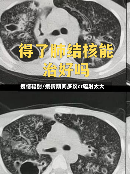 疫情辐射/疫情期间多次ct辐射太大