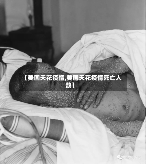 【美国天花疫情,美国天花疫情死亡人数】