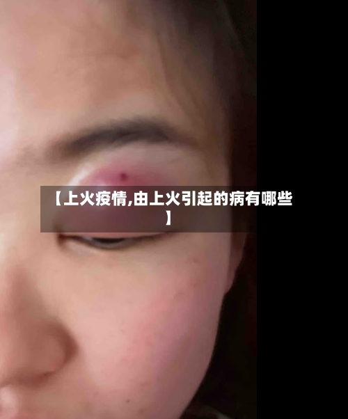 【上火疫情,由上火引起的病有哪些】
