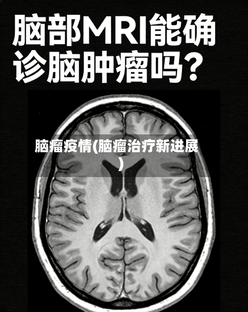 脑瘤疫情(脑瘤治疗新进展)-第2张图片