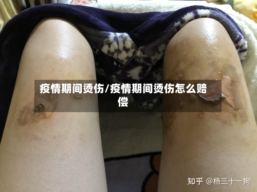 疫情期间烫伤/疫情期间烫伤怎么赔偿-第2张图片