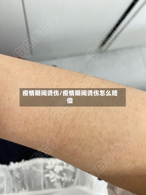 疫情期间烫伤/疫情期间烫伤怎么赔偿-第3张图片